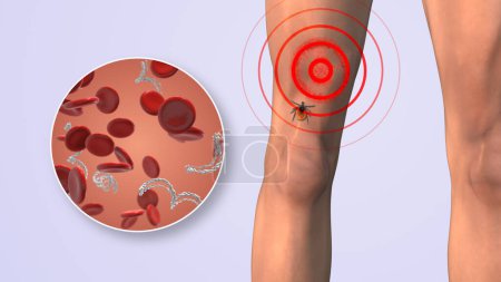 CDC in blood cells with lyme disease on thighs