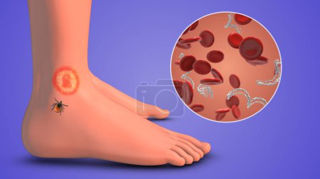 CDC in Blutzellen mit Lyme-Borreliose an Füßen