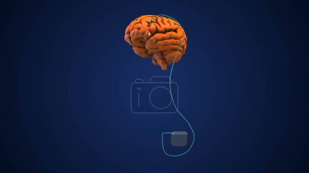 Deep brain stimulation as a medical concept