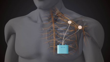 Therapy using peripheral nerve stimulation in the shoulder region