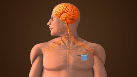 Photo for Medical treatment with Vigus Nerve Stimulation - Royalty Free Image