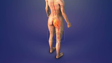 Trigger point for sciatica in human glutes