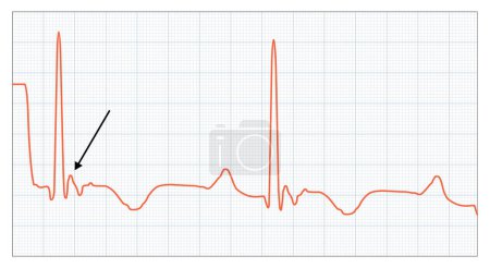 Illustration for Epsilon Wave - ECG, Posterior myocardial, ventricular, Infiltrative disease test chart - Royalty Free Image