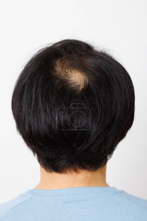 Photo for Man having hair loss problem - Royalty Free Image