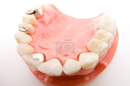 Photo for Implant and orthodontic model for student to learning teaching model showing teeth - Royalty Free Image