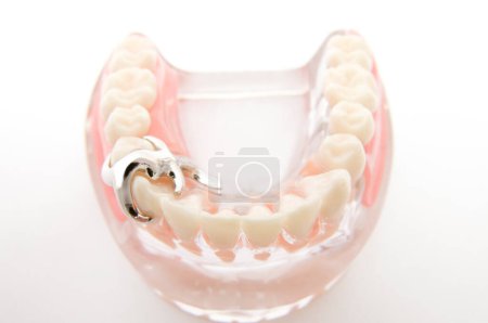 Téléchargez les photos : Modèle d'implant et d'orthodontie pour l'apprentissage d'un modèle d'enseignement montrant des dents - en image libre de droit