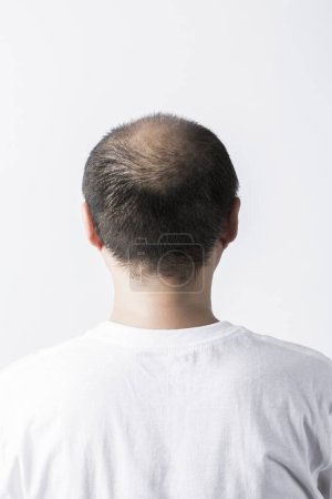 Téléchargez les photos : Homme perdant le thème des cheveux. Tête avec des cheveux de tri et tache de calvitie. Studio tourné sur fond blanc - en image libre de droit