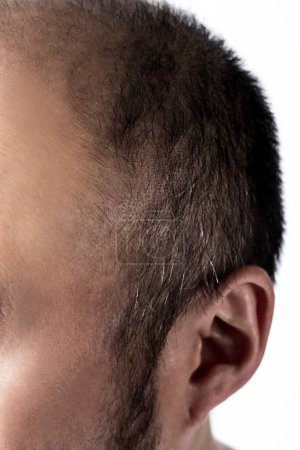 Photo for Man loosing hair theme. Head with sort hair and baldness spot. Studio shot on white background - Royalty Free Image