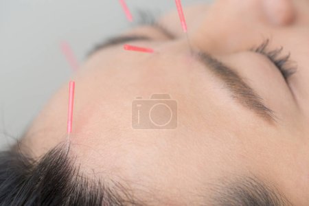 Beautiful Japanese Woman Getting Acupuncture Treatment In Beauty Spa