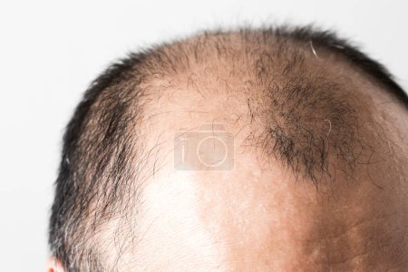 Photo for Man loosing hair theme. Male head with sort hair and baldness spot. Studio shot on white background - Royalty Free Image