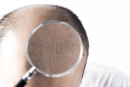 Photo for Man loosing hair theme. Head with sort hair and baldness spot. Studio shot on white background - Royalty Free Image