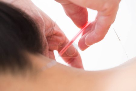 Photo for Close up of acupuncture session - Royalty Free Image