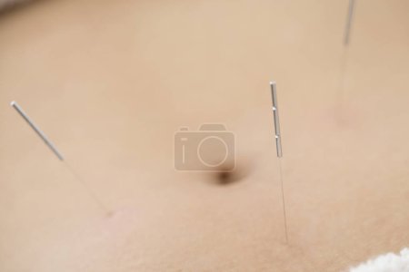 Téléchargez les photos : Gros plan de la séance d'acupuncture - en image libre de droit