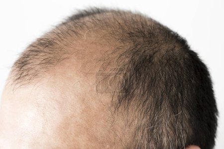 Photo for Man loosing hair theme. Male head with sort hair and baldness spot. Studio shot on white background - Royalty Free Image