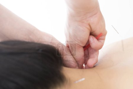 Photo for Close up of acupuncture session - Royalty Free Image
