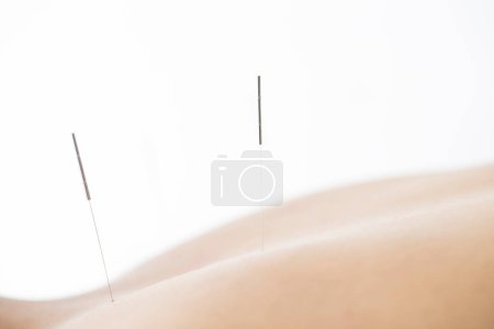 Téléchargez les photos : Gros plan de la séance d'acupuncture - en image libre de droit