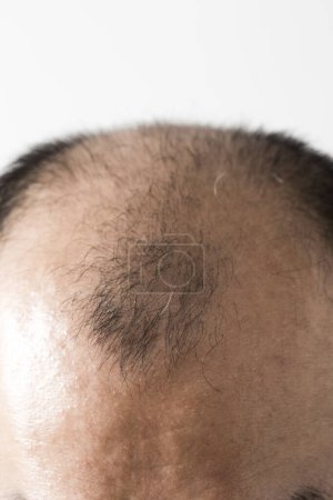 Téléchargez les photos : Homme perdant le thème des cheveux. Tête masculine avec des cheveux de tri et tache de calvitie. Studio tourné sur fond blanc - en image libre de droit