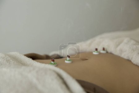 Photo for Beautiful Japanese Woman Getting Acupuncture Treatment In Beauty Spa - Royalty Free Image