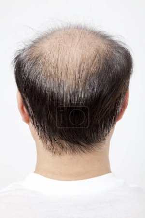 Téléchargez les photos : Homme perdant le thème des cheveux. Tête avec des cheveux de tri et tache de calvitie. Studio tourné sur fond blanc - en image libre de droit