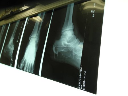 Foto de X - imagen de rayos con pie humano en el fondo, primer plano - Imagen libre de derechos