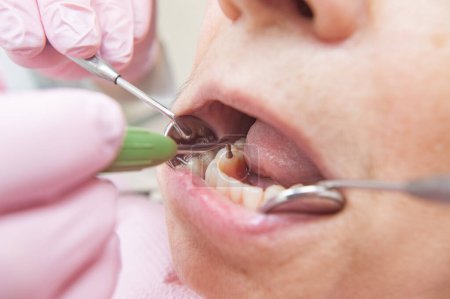 Téléchargez les photos : Ensemble de prothèses dentaires. Fermez la photo des dents. Dentiste examinant un patient - en image libre de droit
