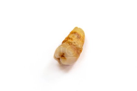 Foto de Un diente cercano con caries dental severa también conocida como caries dental o caries debido a la mala higiene bucal, aislado sobre fondo blanco - Imagen libre de derechos