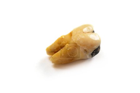 Téléchargez les photos : Une dent de gros plan avec une carie dentaire sévère également connue sous le nom de caries dentaires ou de caries dues à une mauvaise hygiène buccodentaire, isolée sur fond blanc - en image libre de droit
