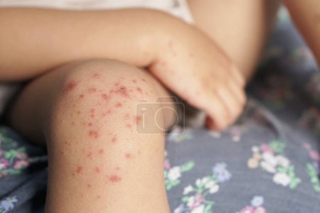 Vista de cerca de la rodilla del niño infectada con la enfermedad de las manos y la boca o la fiebre aftosa originada por enterovirus o virus coxsackie, rojo fuerte en la piel. acercamiento vista zoom tiro.