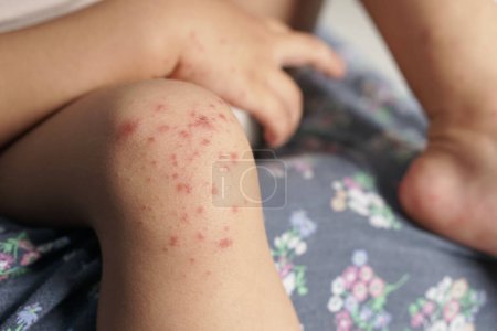 Nahaufnahme des Knies eines Kindes, das mit der Hand- und Mundkrankheit oder HFMD infiziert ist, die von Enteroviren oder Coxsackie-Viren ausgeht, die rot und hart auf der Haut sind. Nahaufnahme Zoomaufnahme.