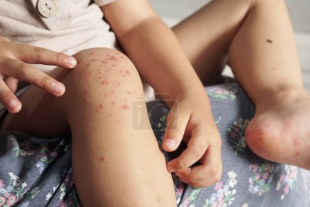 Junge mit einem Knie, das mit einer Hand- und Mundkrankheit oder HFMD infiziert ist, die von Enteroviren oder Coxsackie-Viren ausgeht, Nahaufnahme Zoom.