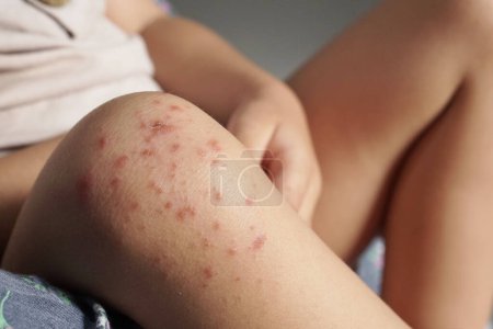 Nahaufnahme des Knies eines Kindes, das mit der Hand- und Mundkrankheit oder HFMD infiziert ist, die von Enteroviren oder Coxsackie-Viren ausgeht, Nahaufnahme Zoomaufnahme.