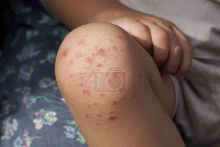 Knie eines Kindes, das mit der Hand- und Mundkrankheit oder HFMD infiziert ist, die vom Enterovirus oder Coxsackie-Virus ausgeht, Nahaufnahme Zoom-Aufnahme.