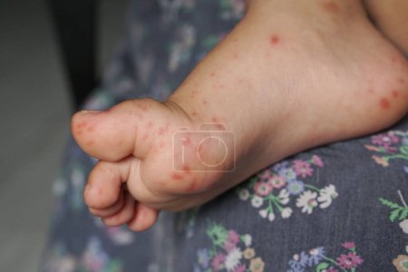Close up view of child's feet infected with hand feet and mouth disease or HFMD originating from enterovirus or coxsackie virus, close up view zoom shot.