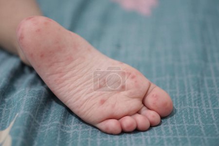 Vista de cerca de los pies del niño infectados con la enfermedad de las manos y la boca o la fiebre aftosa originada por enterovirus o virus coxsackie, zoom shot.