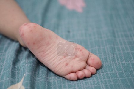 close up view of child's feet infected with hand feet and mouth disease or HFMD originating from enterovirus or coxsackie virus, zoom shot.