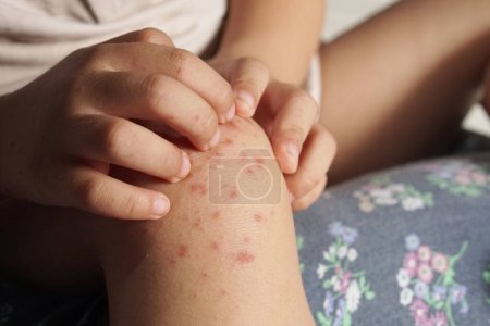 Téléchargez les photos : Vue rapprochée de l'enfant qui se gratte le genou à cause d'une infection par la fièvre aphteuse causée par un entérovirus ou un virus coxsackie, - en image libre de droit