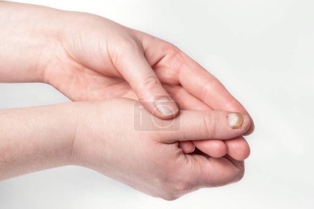 A nail in need of treatment for a fungal infection. Fungal diseases of parts of the body