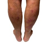 Womens Legs and thighs in very severe psoriasis. Bleeding lesions. Older women. White background. . High quality photo