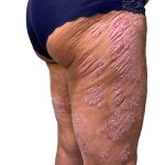 Womens Legs and thighs in very severe psoriasis. Bleeding lesions. Older women. White background. . High quality photo
