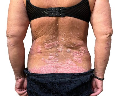 La espalda de una anciana blanca en lesiones muy graves de psoriasis. Llagas rosas y rojas. Fondo blanco. Foto de alta calidad