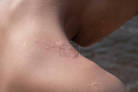 Rash caused by an allergic reaction urticaria,Rash caused by insect bites on skin shoulder,Itchy rash caused by water allergy,skin disease, skin symptoms, concept of medical and skin, closeup photo.