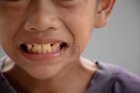 Asiatischer Junge lächelt und zeigt gelbe Zähne oder Zahnfluorose und klaffende Zähne oder Diastema-Konzept der Medizin und Zahnmedizin für die Mundgesundheit.
