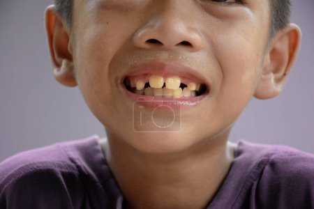 Portrait visage asiatique garçon souriant et montrant des dents jaunes ou fluorose dentaire et dents bénies ou diastème concept de médecine et de dentisterie pour les soins buccodentaires.