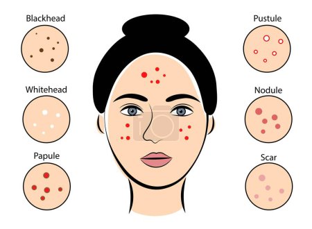 Girl with acne on white background. Vector illustration
