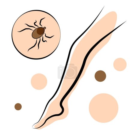Illustration for Encephalic mite. Parasite. Nasikomoe. Vector illustration - Royalty Free Image