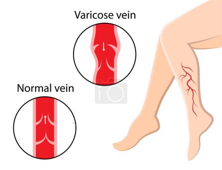 Varicose veins. Pain in the legs. Human Anatomy. Vector illustration