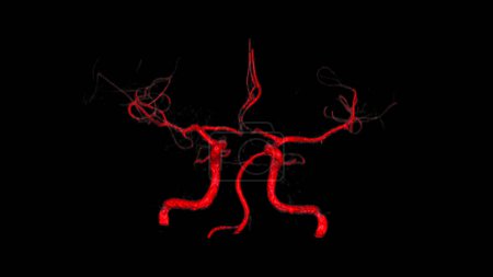 Téléchargez les photos : Reconstruction 3D des données angiographiques obtenues par IRM cérébrale simple montre la configuration des artères cérébrales dans le cerveau humain - en image libre de droit