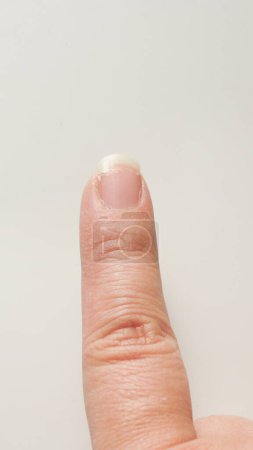 Index finger with cracked and sore nail