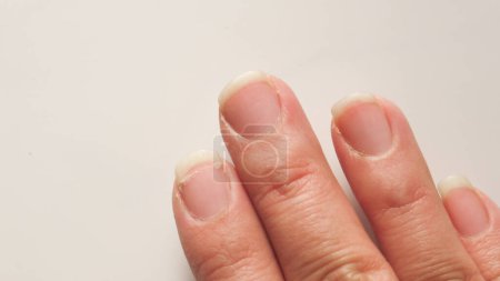 Hands with dry and cracked nails