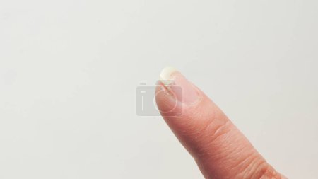Index finger with cracked and sore nail